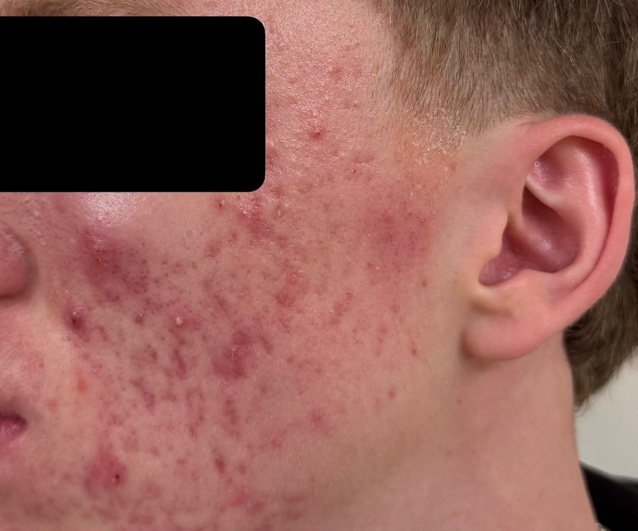 Acne Isn't Just Skin Deep — And You Don't Have to Live With It