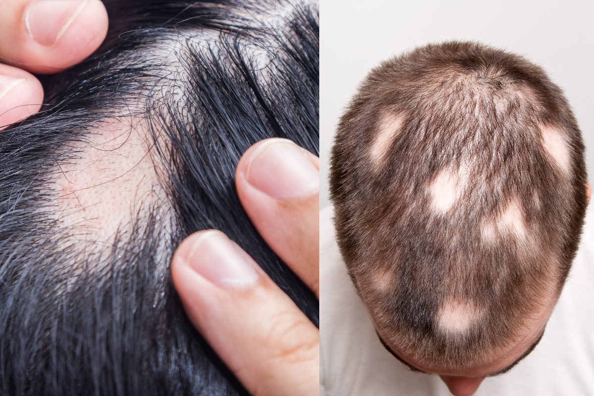 Understanding Alopecia Areata