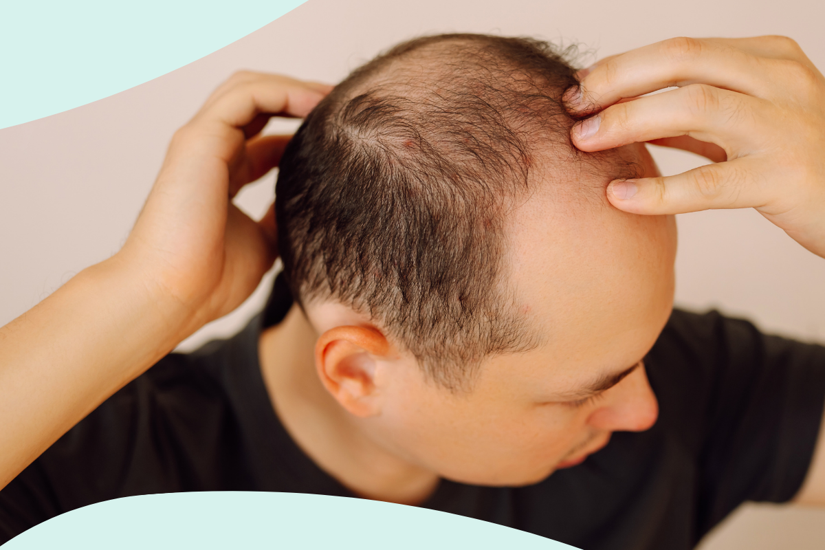 Pattern Hair Loss Explained: Causes, Diagnosis and Treatment Options